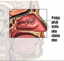 Polyp mũi phát triển như chùm nho trong khoang mũi
