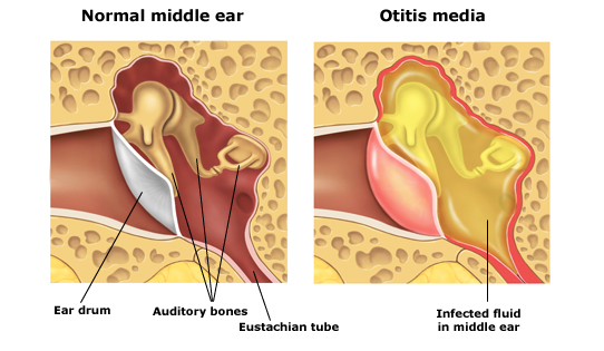 Viêm xoang mũi cũng là nguyên nhân gây viêm tai giữa