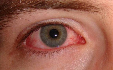 Viêm xoang gây biến chứng có thể gây mù mắt
